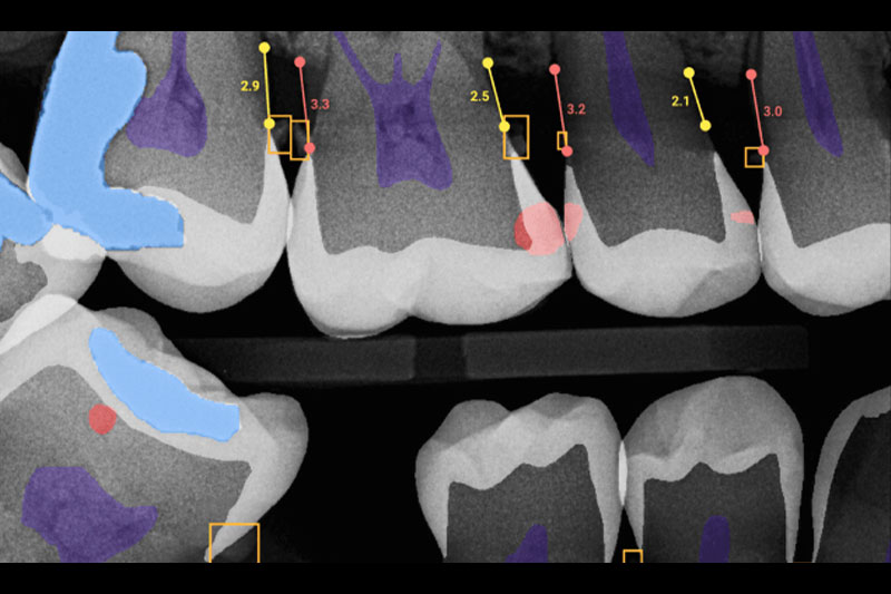 Laser Dentistry in Newark